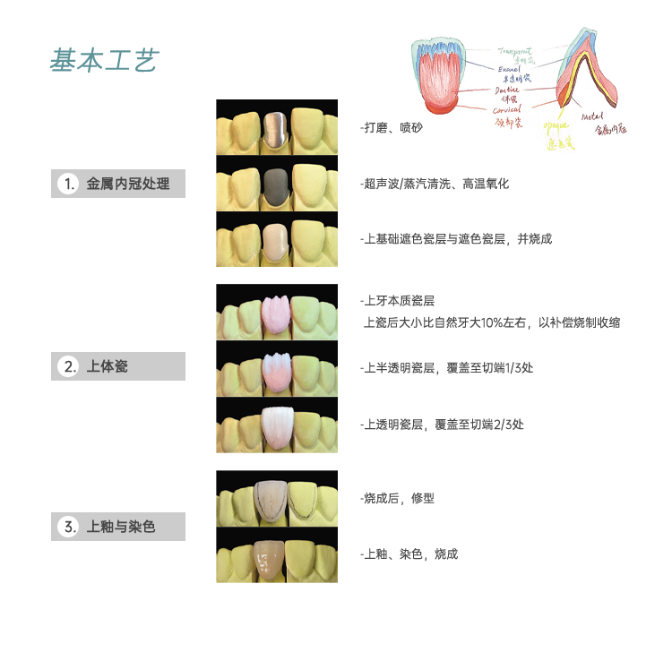 金属烤瓷粉义齿加工基本工艺